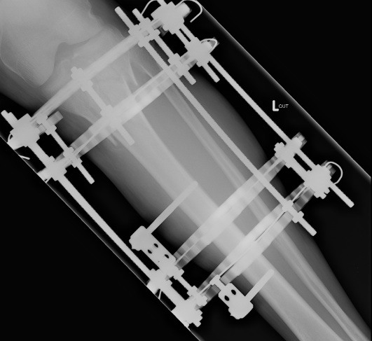 Ilizarov Proximal Tibia